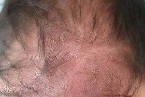 Rambut Rontok: Kurang Vitamin Apa?