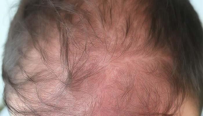 Rambut Rontok Kurang Vitamin Apa