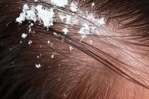 Ketombe dan Rambut Rontok: Memahami Hubungan dan Solusi Efektif