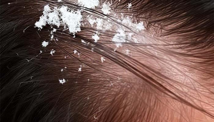 Ketombe dan Rambut Rontok