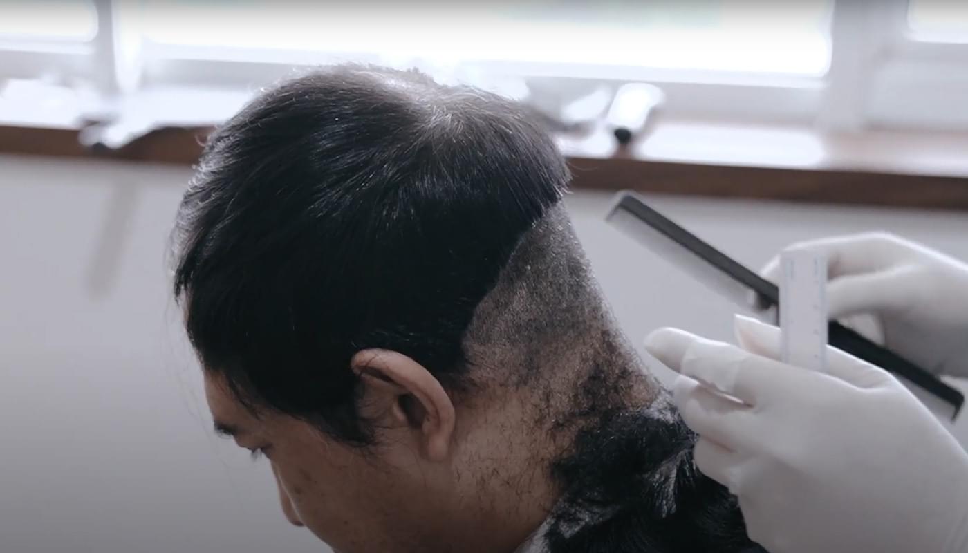 Klinik Rambut Terbaik di Jakarta & Bali: DHI Indonesia Solusinya