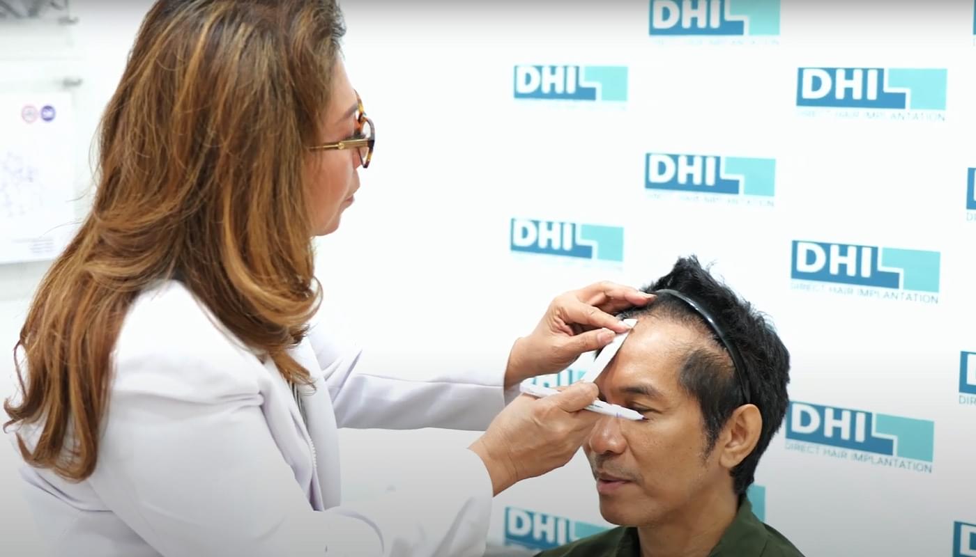 Transplantasi Rambut Gagal: Belajar dari Kisah Ridho Slank, Ini Solusi Perbaikannya